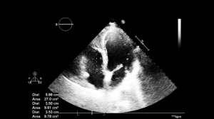 What is Transesophageal Echocardiography? A Beginner’s Guide