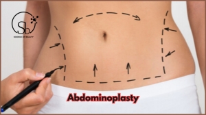 10 Facts You Should Know If You Are Considering Abdominoplasty