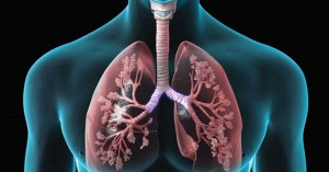 Alpha 1 Lung Disease Market Anticipated to Witness High Growth Owing to Increasing Prevalence of COPD