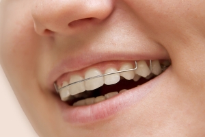 The Role of Dental Retainers in Dubai for Smile Retention