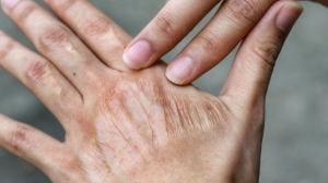 What Kind of Surgery Is Done for Burns?