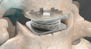 Artificial Disc Market Report, Size, Industry Research, Key Vendors by 2024-2032