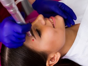 Precision Mole Removal: A Comprehensive Guide to Treatment