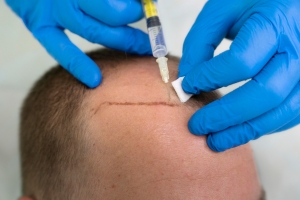 How Lifestyle Choices Impact Hair Health: Tips for Stronger, Fuller Hair