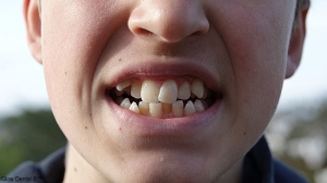 The Best Ways to Treat Crowded Teeth in Dubai: Solutions for Every Smile