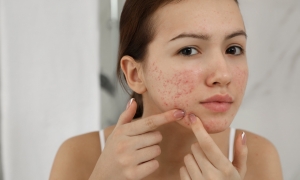 The Secret to Beautiful Skin: Acne Treatment Revealed