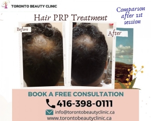 Why Choose PRP Hair Treatment for Male Pattern Baldness