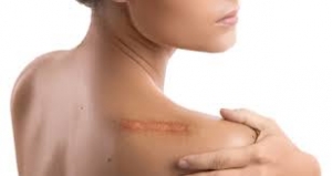 Understanding Keloids: How DNA Skin Clinic Provides Tailored Keloid Treatment in Bangalore