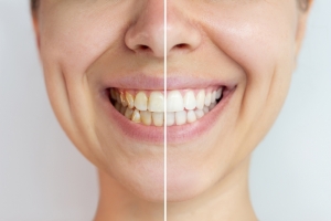 Top Benefits of Professional Teeth Whitening Services in Roslindale