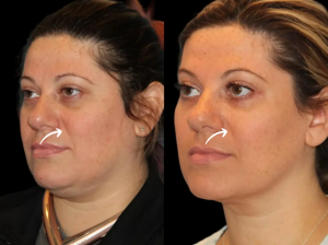 Why Choose the Best Sculptra Dermatologists in Dubai for Anti-Aging?