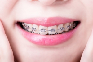 Dental Braces Aftercare: How to Ensure a Smooth and Successful Treatment