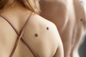 Your Guide to Affordable and Effective Skin Tag Removal in Bangalore