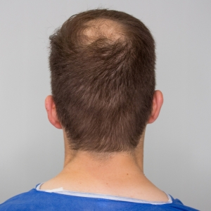 Unlock a New Look with Crown Hair Transplant