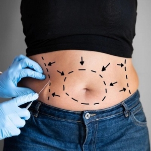 Liposuction vs. Diet and Exercise: What’s the Better Path to a Slimmer You?