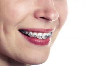 Life After Braces: Retainers and Maintaining Your Smile