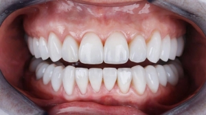 The Science Behind E-Max Veneers and Their Popularity in Dubai
