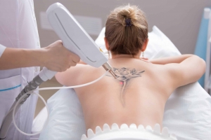 Laser Tattoo Removal: Restore Your Natural Skin