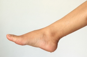 The Ultimate Guide to Botox for Foot Sweating in Riyadh