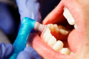 Teeth Polishing & Scaling in Dubai Your Path to Better Oral Care
