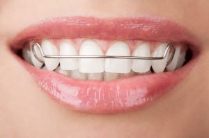 Get a Perfect Fit with Dental Retainers in Dubai