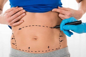 What You Need to Know Before Liposuction Surgery