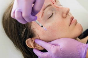 Top 5 Signs You’re Ready for a Vampire Facial in Warrenton