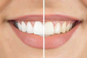 Brighter Smiles Start Here: Your Guide to Whitening Options