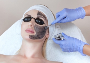 Laser Carbon Peel: Discover the Benefits for Your Skin