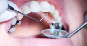 SMART Dental Amalgam Removal The Mercury-Free Solution for Your Smile