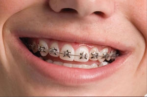 Explore Expert Dental Appliances for Perfect Teeth in Dubai