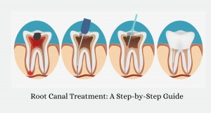 Root Canal Treatment: A Step-by-Step Guide