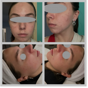 Microneedling for acne scars