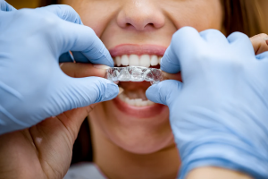 Aligners vs Braces Why Dubai Chooses Clear Aligners for Teeth Alignment