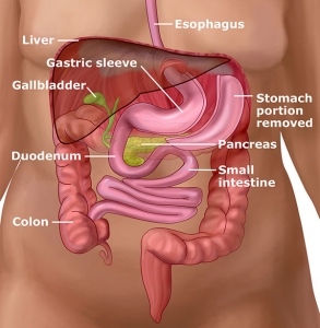 Your Guide to Laparoscopic Gastric Sleeve Surgery Cost in Riyadh