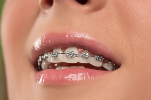 Clear Braces vs. Metal Braces: What's Best in Dubai?