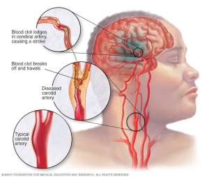 Carotid Artery Disease Market Size, Demand, Trends, Top Companies & Forecast - 2024-2034