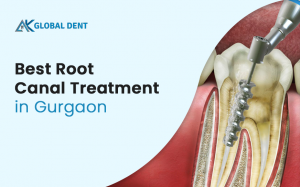 Do I Need a Root Canal if There Is No Pain?