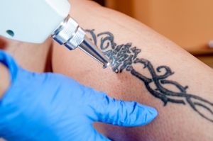 How to Care for Skin After Laser Tattoo Removal