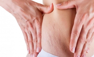 How to Deal With Pregnancy Stretch Marks?