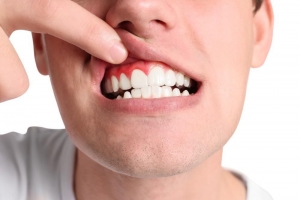Gingivectomy Procedure in Dubai Reshape Your Gums for Better Health