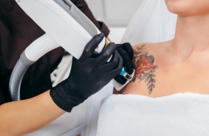 The Truth About Laser Tattoo Removal Costs in Dubai