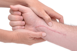 Transformative Results: Laser Scar Removal Insights