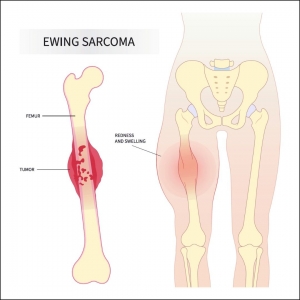 Ewing’s Sarcoma Market Size, Share, Trends, Industry Report 2024-34