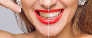 Radiant Teeth in No Time Fast Teeth Whitening in Dubai