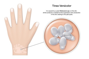 Dermatomycosis Market Size, Industry Trends, Growth 2024-34