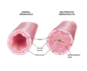 Bronchiolitis Obliterans Syndrome Market Size, Share, Trends, Industry Analysis, Report 2024-2034