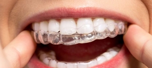 Dubai Aligners: Revolutionizing Teeth Alignment