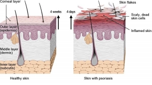 Plaque Psoriasis Market Share, Industry Trends, Forecast 2024-34