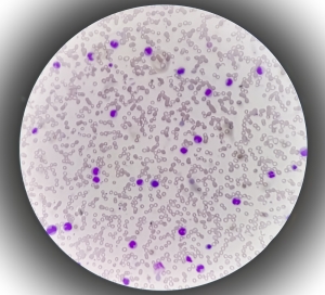 eosinophilic asthma clinical trials