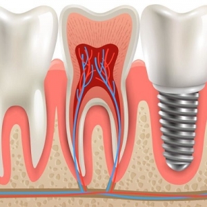 Root Canal Specialist in Dubai